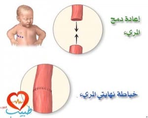 طبيب ع اطفال رتق مريء