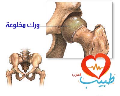 طبي غ اطفال خلع ورك