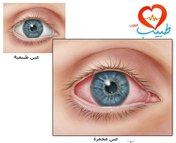 أسباب احمرار العين