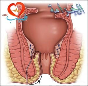 طبيب ع داخلية نواسير خزامة