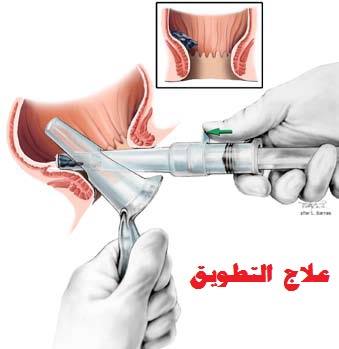 علاج البواسير علاج البواسير الخارجية