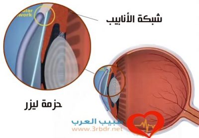 جراحة الماء الزرقاء بالليزر