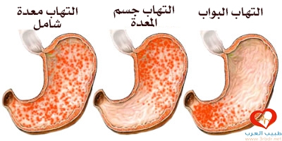 أعراض التهاب المعدة والقولون