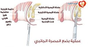 بضع المصرة الجانبي Lateral sphincterotomy