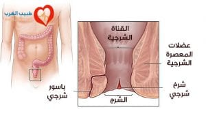 علاج الشرخ الشرجي