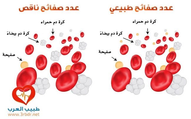 نقص صفائح الدم