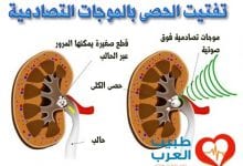 تفتيت الحصى بالموجات التصادمية