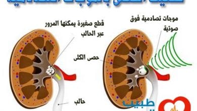 تفتيت الحصى بالموجات التصادمية