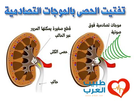 تفتيت الحصى بالموجات التصادمية