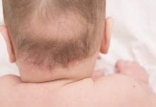تساقط شعر الأطفال الرضع