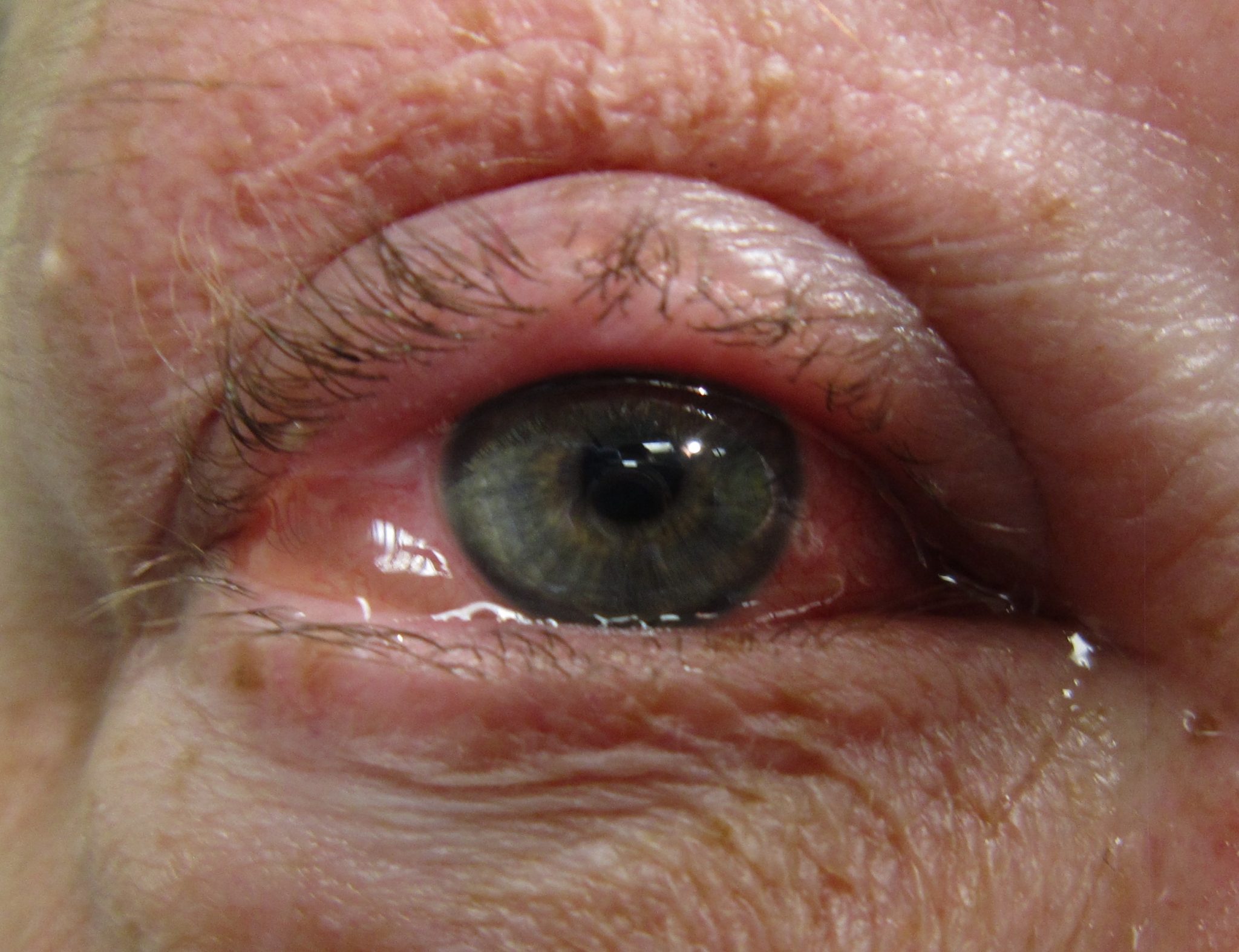 اضرار قطرة بريزولين للعين وأعراضها الجانبية وموانع استخدامها | طبيب العرب