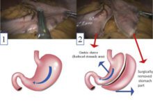 جراحة تكميم المعدة